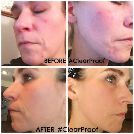 Mary Kay® Clear Proof Acne Treatment Gel – Fast Spot Treatment for Acne